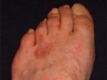 l�bfej ekc�ma. Eczema foot